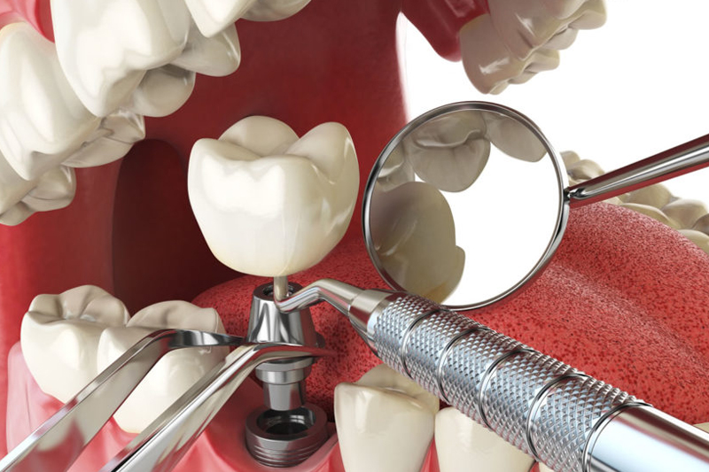 Dental Implants in Vancouver